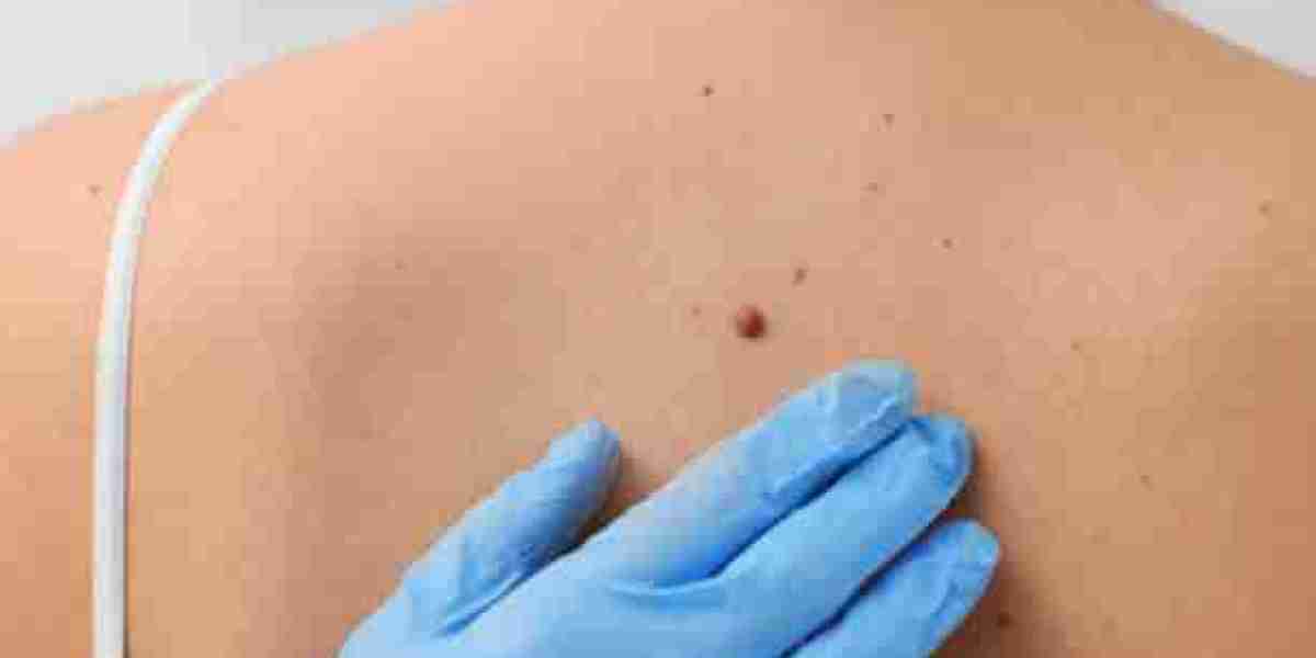 Skin Tag Removal Guidance for Better Skin Texture Control